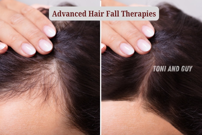Advanced hair fall therapy results at Toni & Guy Coimbatore showing before and after scalp improvement